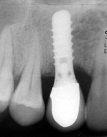 RTG obraz implantátu nahrazující 1 zub